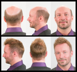 Pelucas oncologicas donostia Clearance