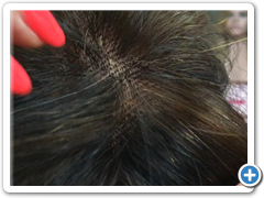 protesis alopecia toa MINI 2H5.7